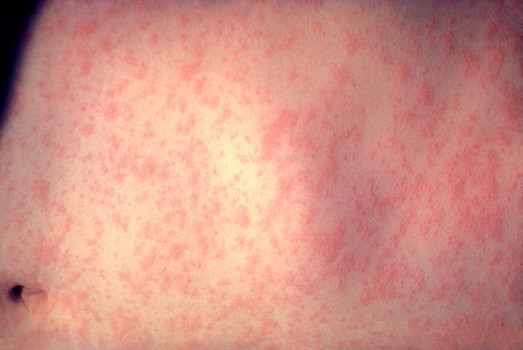 measles (creative commons)